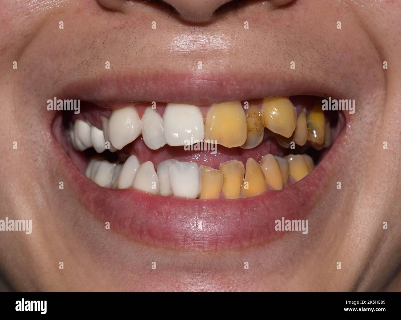 Comparison of before and after scaling and polishing treatment for tobacco stains on crowded teeth of Asian young man. Resulting in white and brighten Stock Photo
