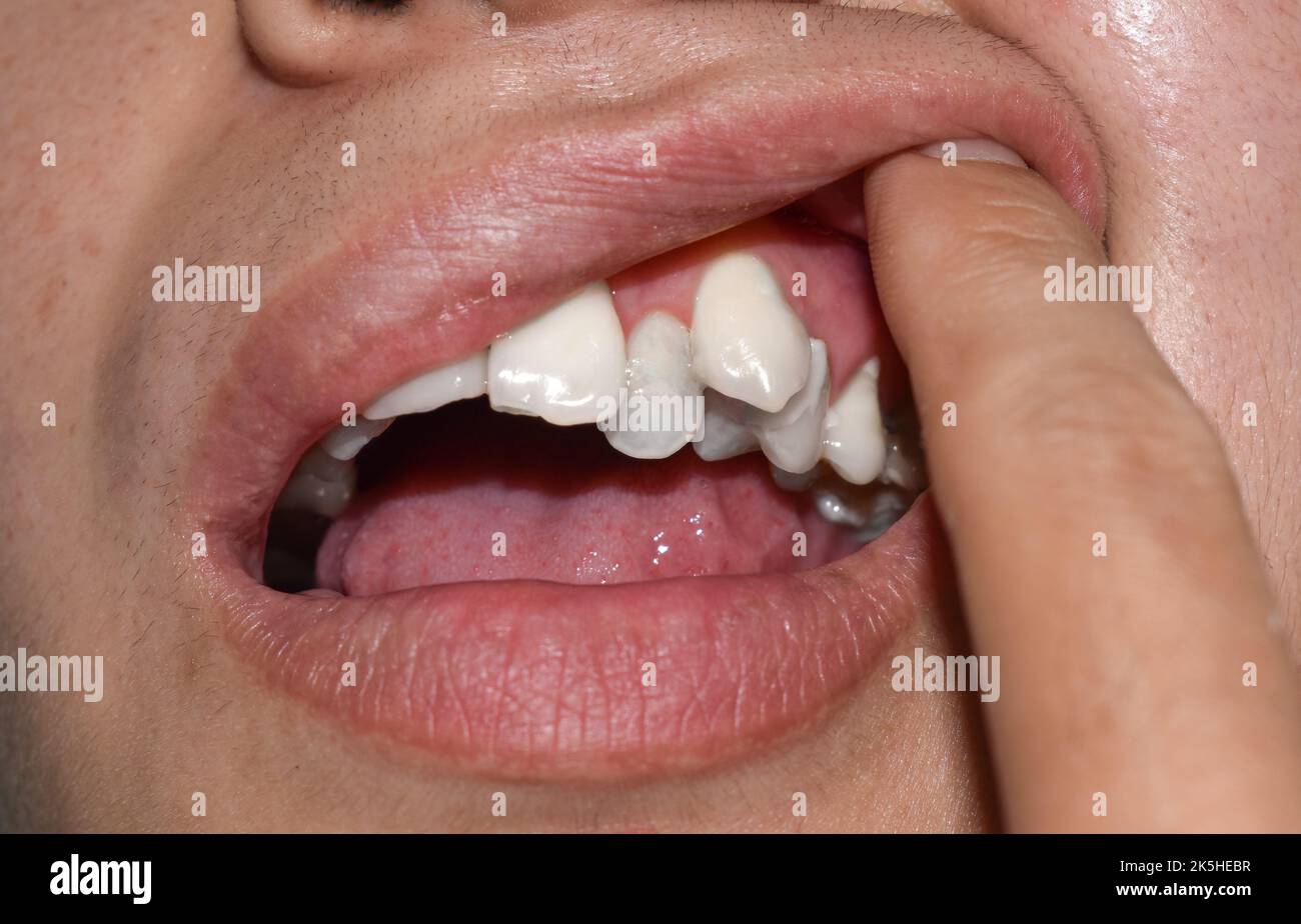 Stacked or overlapping white teeth of Asian man. Also called crowded teeth. Stock Photo