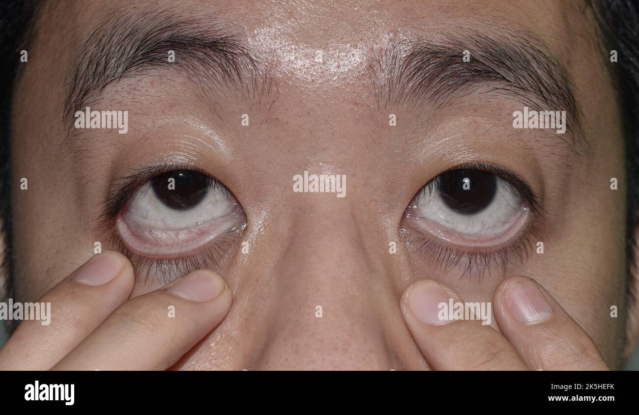 Pale skin of Asian young man. Sign of anemia. Pallor at eyelid. Stock Photo