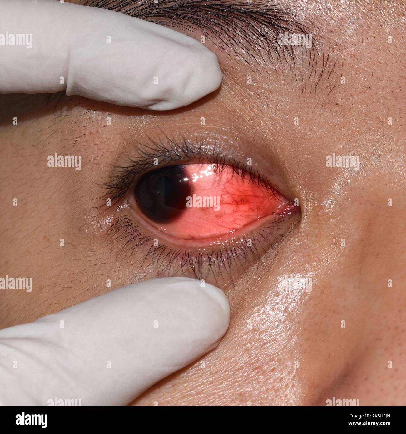 Keratitis hi-res stock photography and images - Alamy