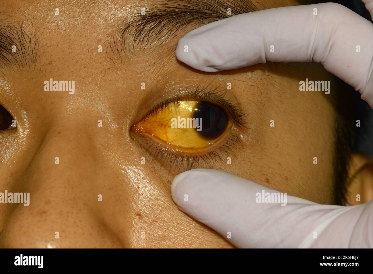 Deep jaundice in Asian male patient. Yellowish discoloration of skin