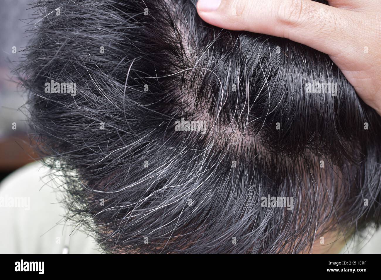 Premature Greying Of Hair (White Hair) - Treatment, Symptoms & Risk Factors