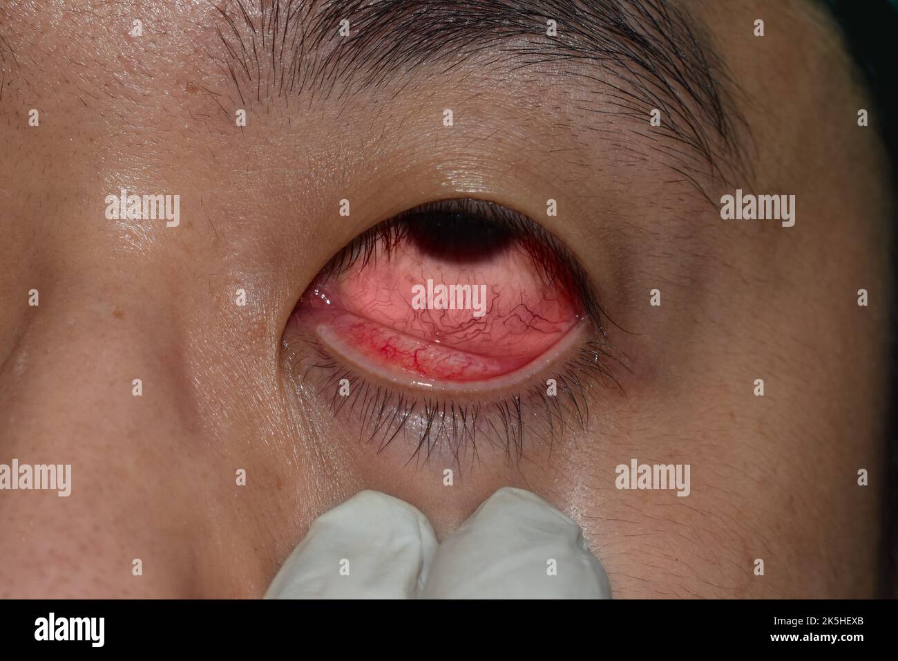 Corneal infection or ulcer called keratitis in Asian young man. Stock Photo