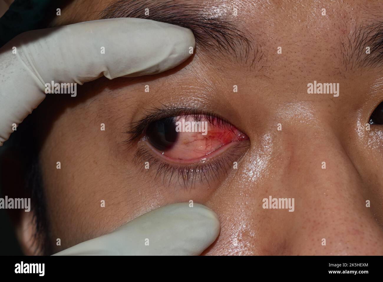 Corneal infection or ulcer called keratitis in Asian young man. Stock Photo