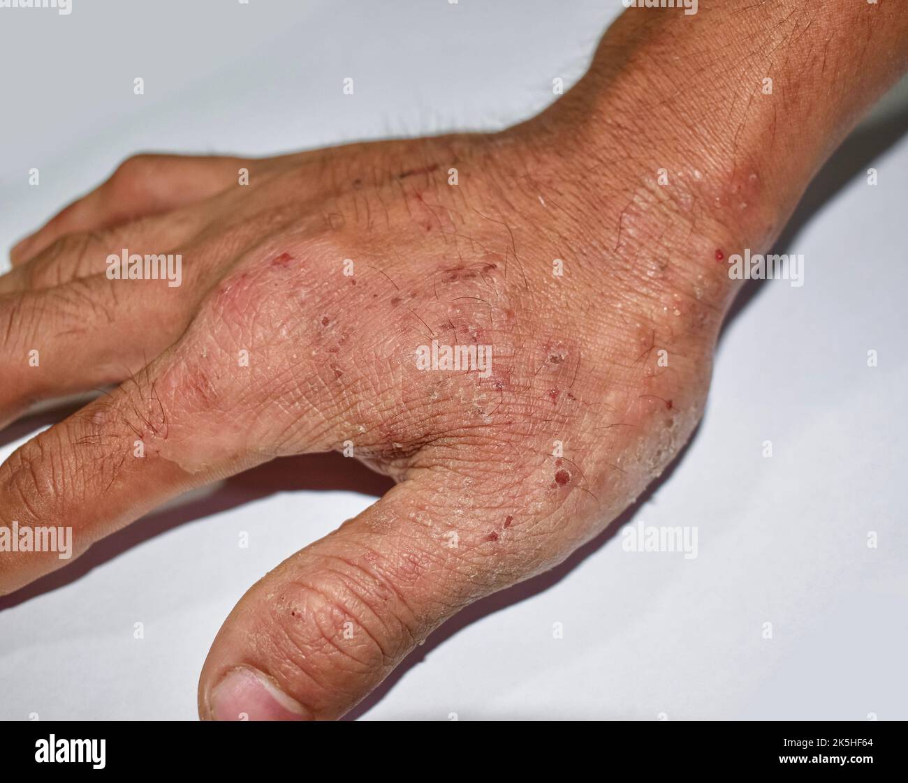 Itchy skin lesions in hand of Asian adult man. It may be caused by scabies infestation or fungal infection. Stock Photo