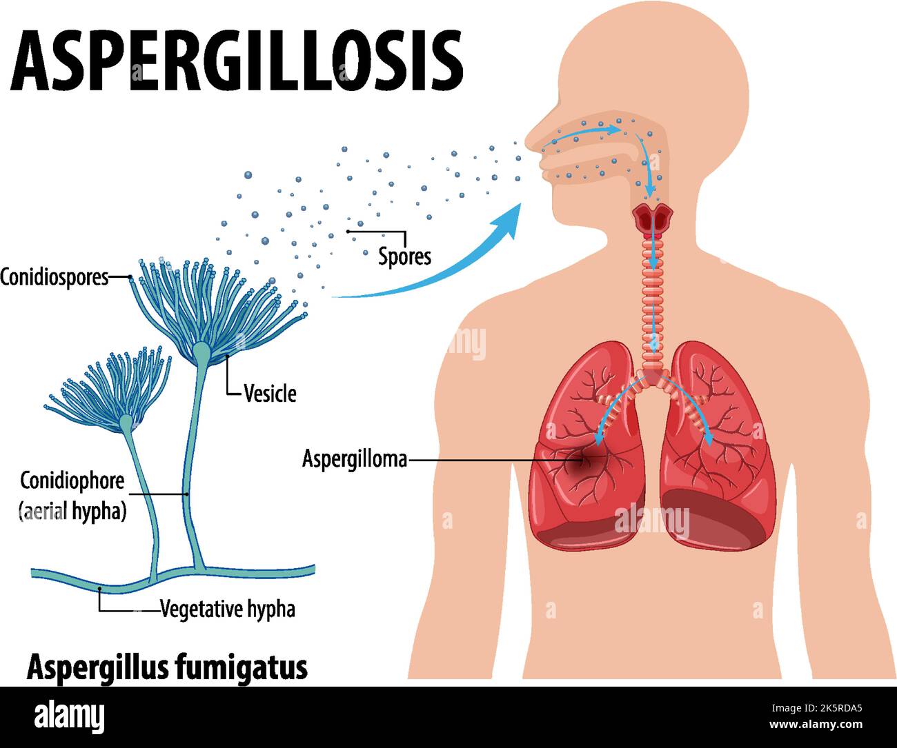 Diagram showing aspergillus infection illustration Stock Vector Image ...