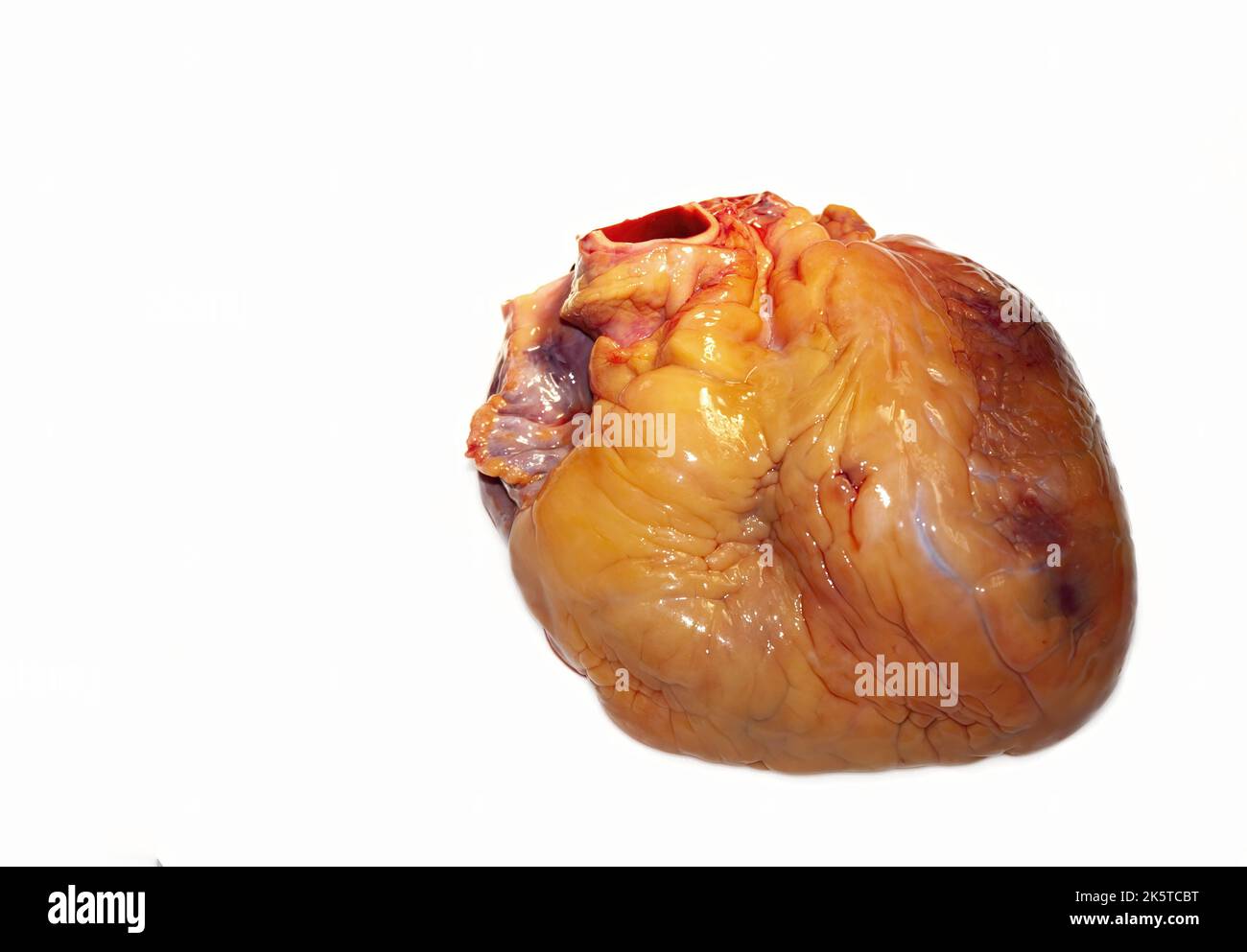 A fatty heart isolated on a white background with symptoms of cardiac distress, Stock Photo