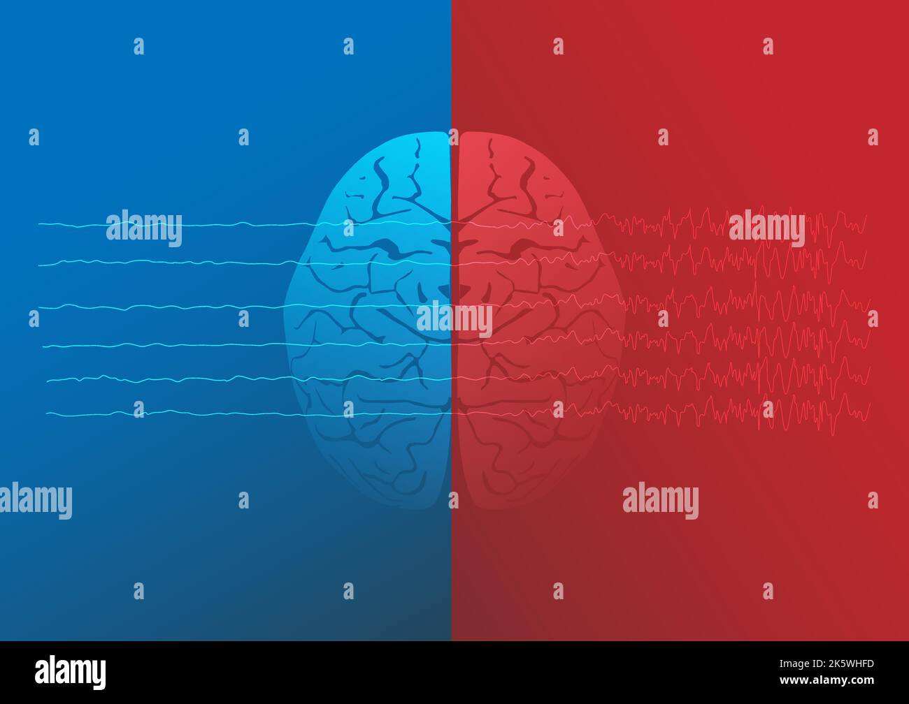Illustration of human normal brain and epileptic brain. Brain waves of focal seizure. Stock Vector