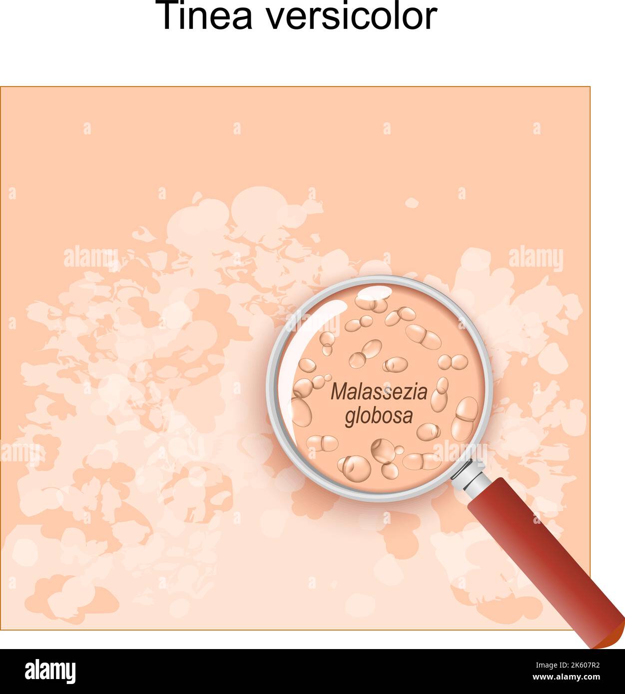 Tinea versicolor. Human skin with symptoms of pityriasis versicolor. Close-up of Malassezia globosa fungus that caused of skin diseases like tinea Stock Vector