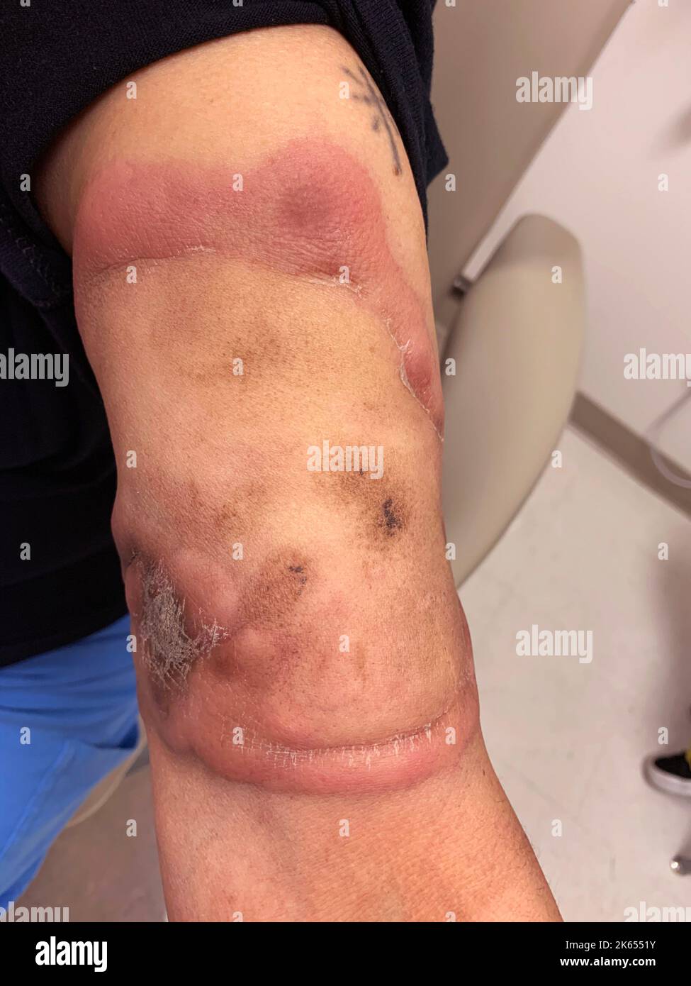 Cutaneous T cell lymphoma Stock Photo - Alamy
