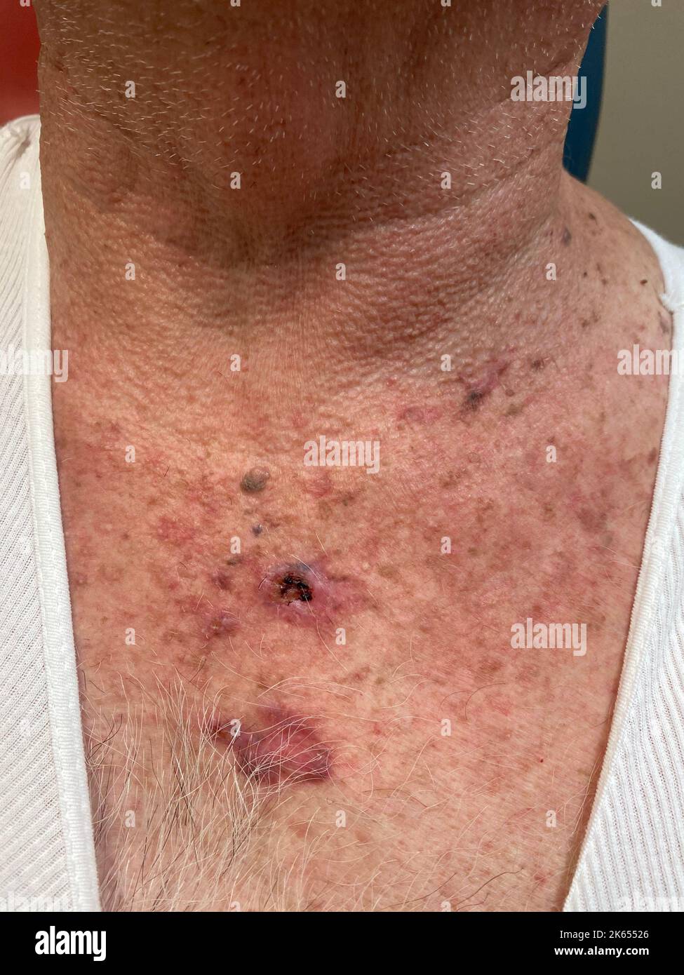 Nodular basal cell carcinoma Stock Photo Alamy