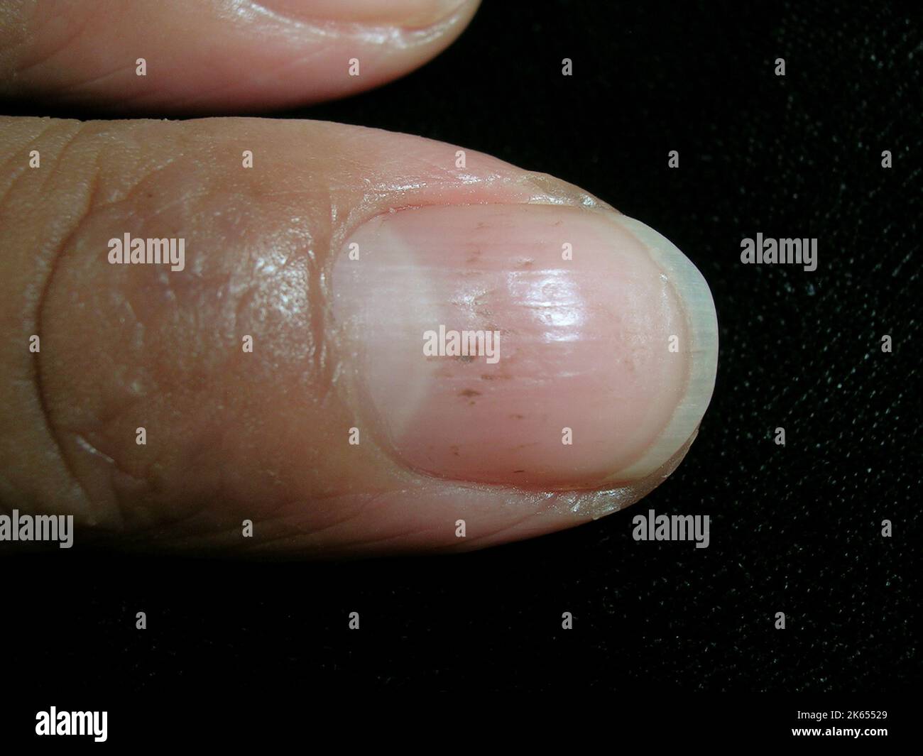 Pitted nail due to severe atopic dermatitis Stock Photo Alamy