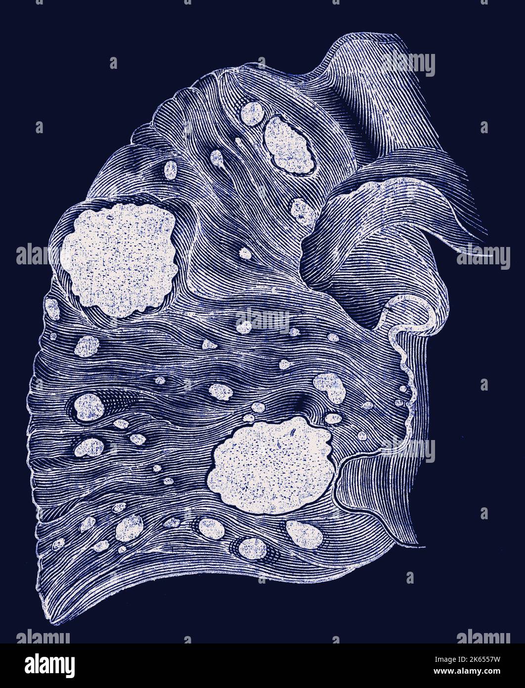 Melanosis of the intestine, illustration Stock Photo