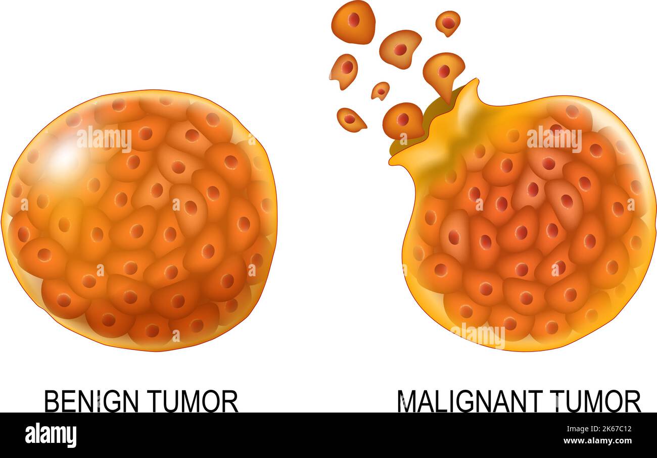 Cancer cells in Benign neoplasm and Malignant tumors. Close-up of carcinocytes that have the ability to metastasis (right). Cells of non-cancerous Stock Vector