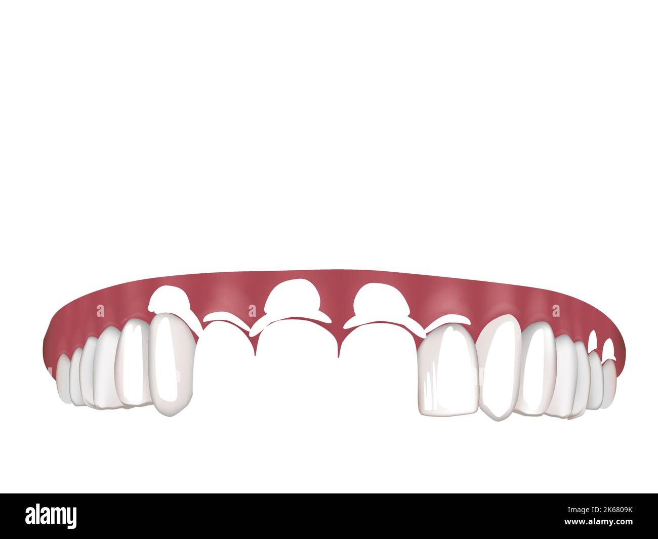 Maxillary Implant Supported Fixed Prosthesis. Maxillary overdentures supported by four implants. Procedure on the All in Four dental implants. Stock Vector