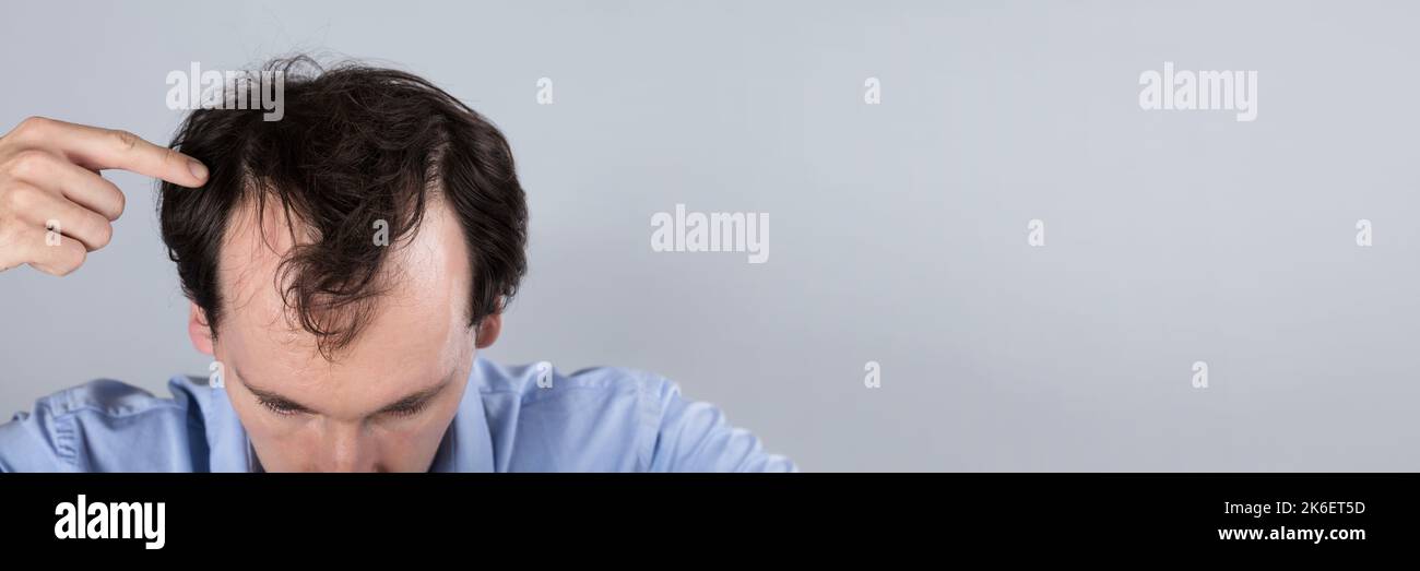 Balding Man Losing Hair. Head Scalp Dandruff Treatment Stock Photo Alamy