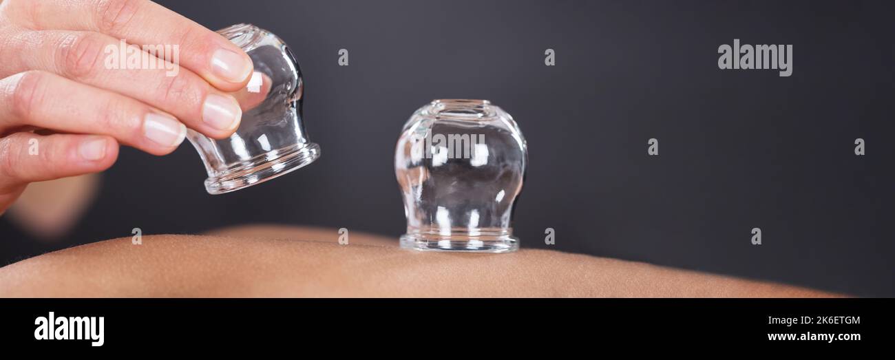 Cupping therapy hand hires stock photography and images Alamy