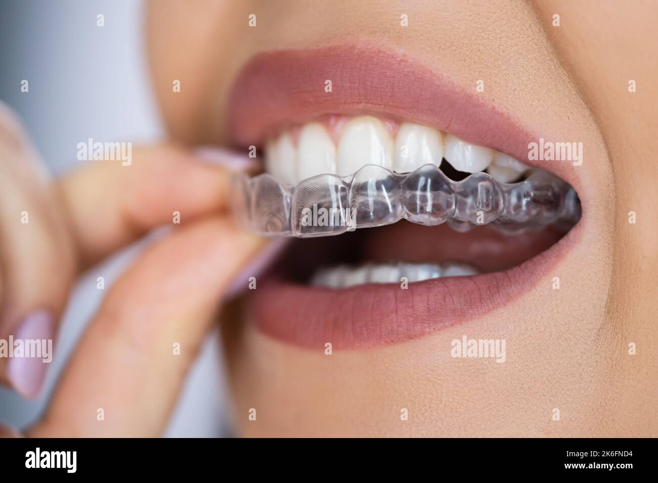 Clear Aligner Dental Night Guard For Teeth Stock Photo Alamy