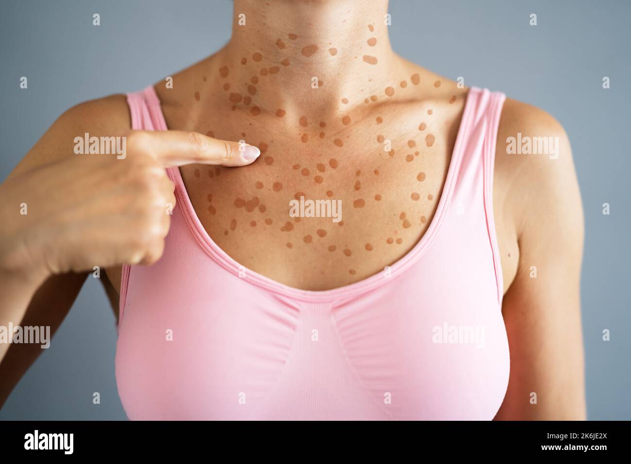 Woman Body Skin Rash With Red Allergy Eruption Stock Photo