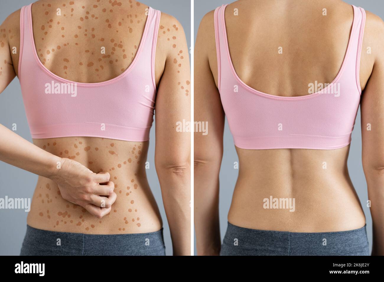 Woman Body Skin Rash Treatment Before After Stock Photo