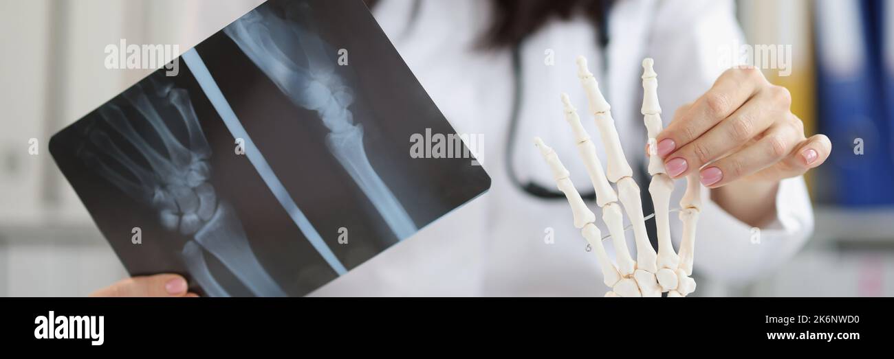 Broken hand x ray hires stock photography and images Alamy