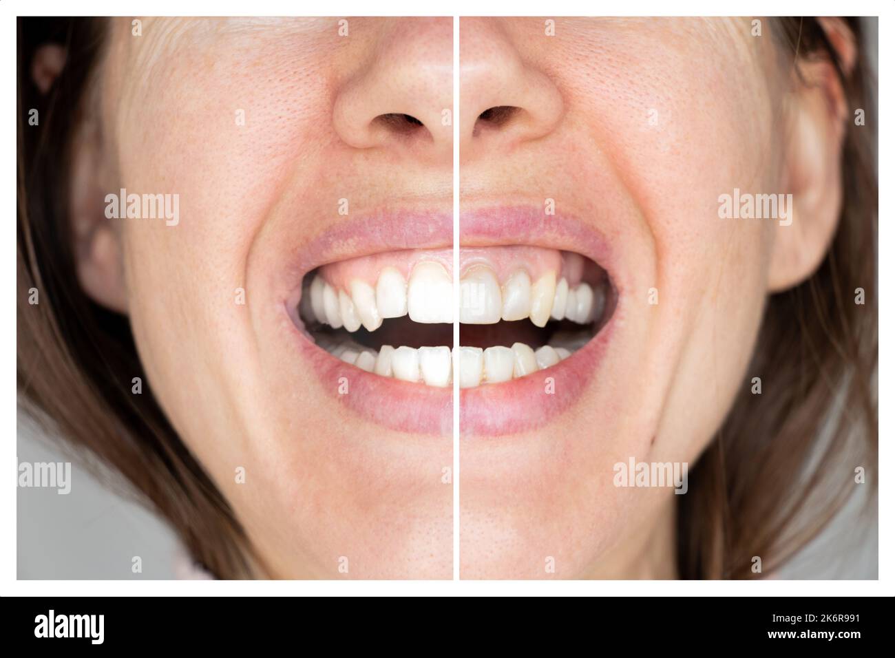 Women's teeth before and after bleaching an example on the same