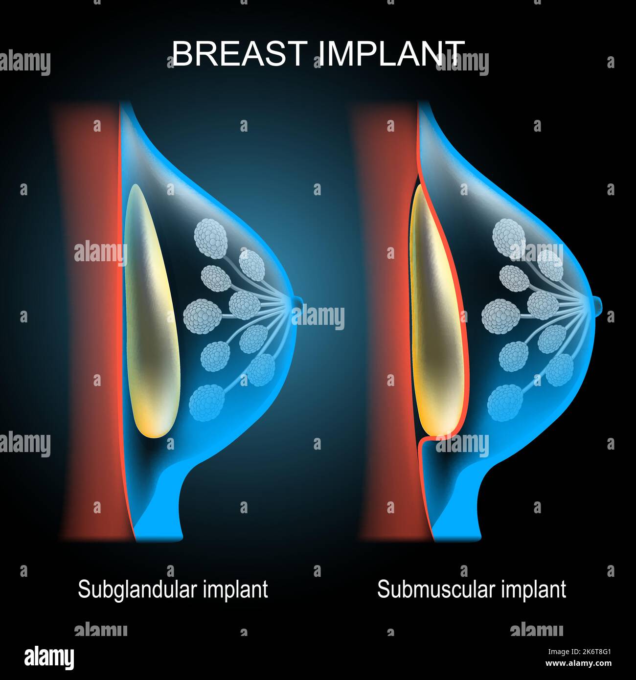 Breast implant placement comparison. 3d realistic poster. cross section of scheme of the mammary gland with implant. x-ray blue scanning. Stock Vector