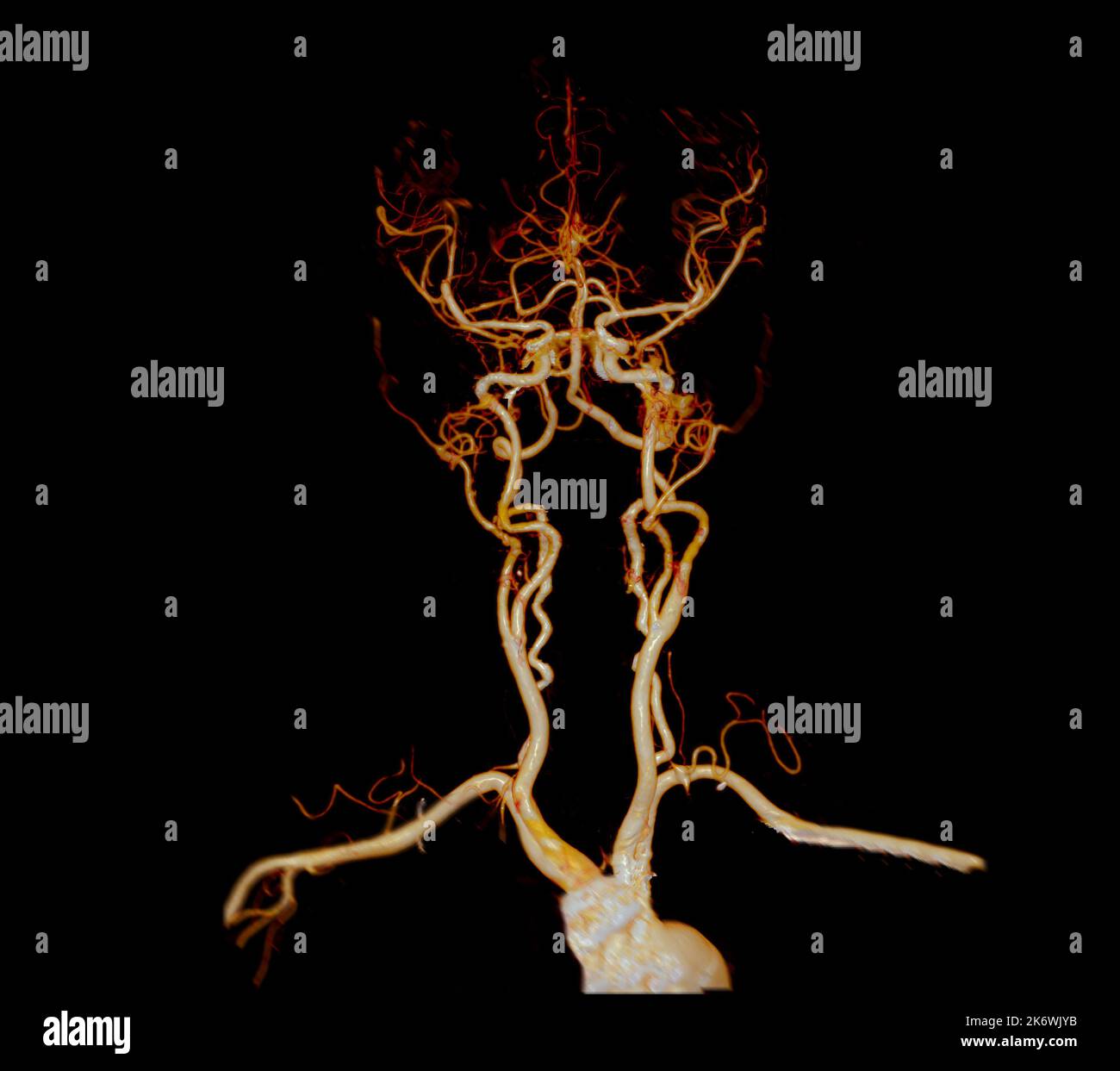 CTA brain or CT angiography of the brain  3D Rendering image for diagnosis cerebral artery aneurysm. Stock Photo