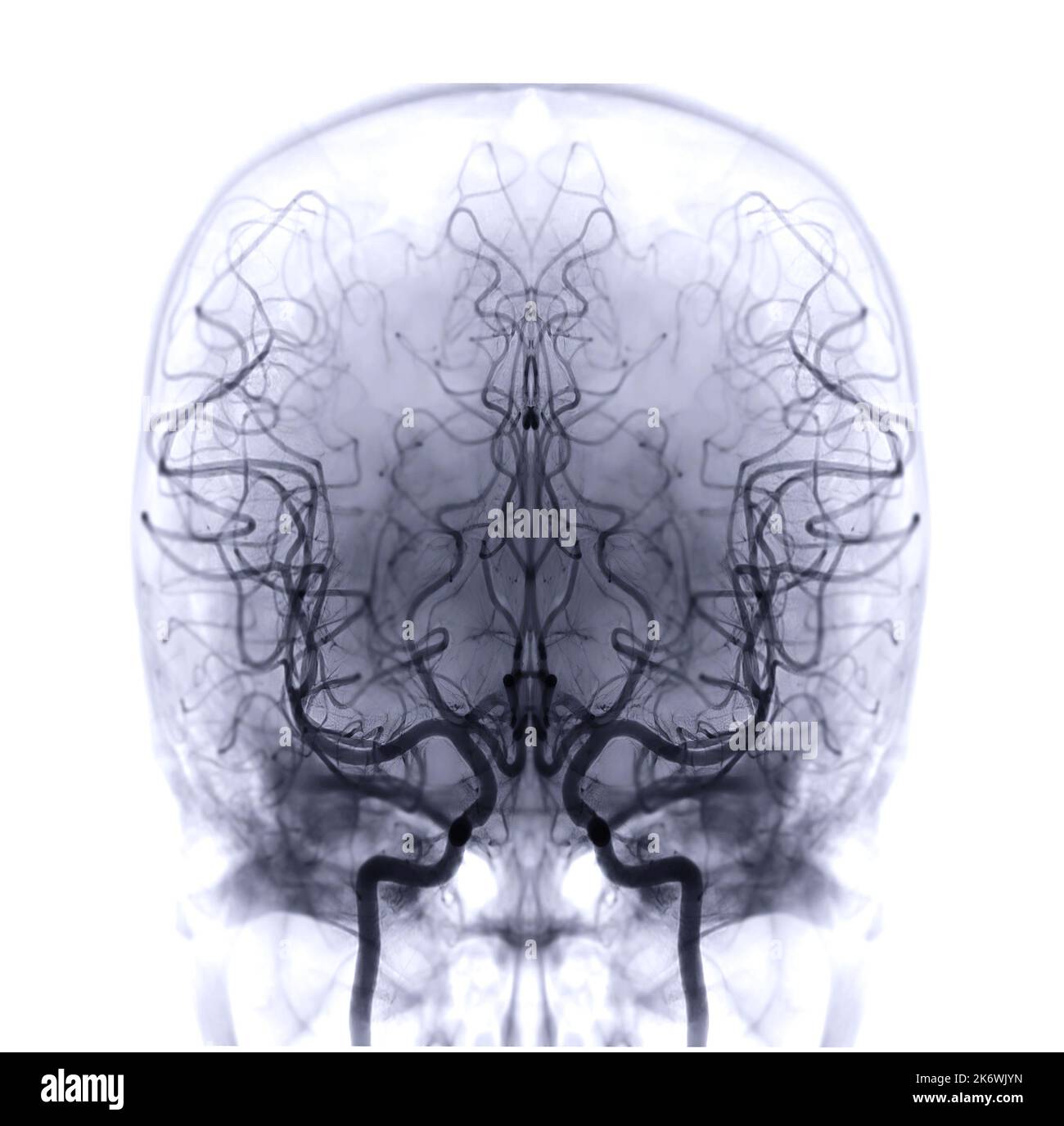 Cerebral angiography image from Fluoroscopy in intervention radiology