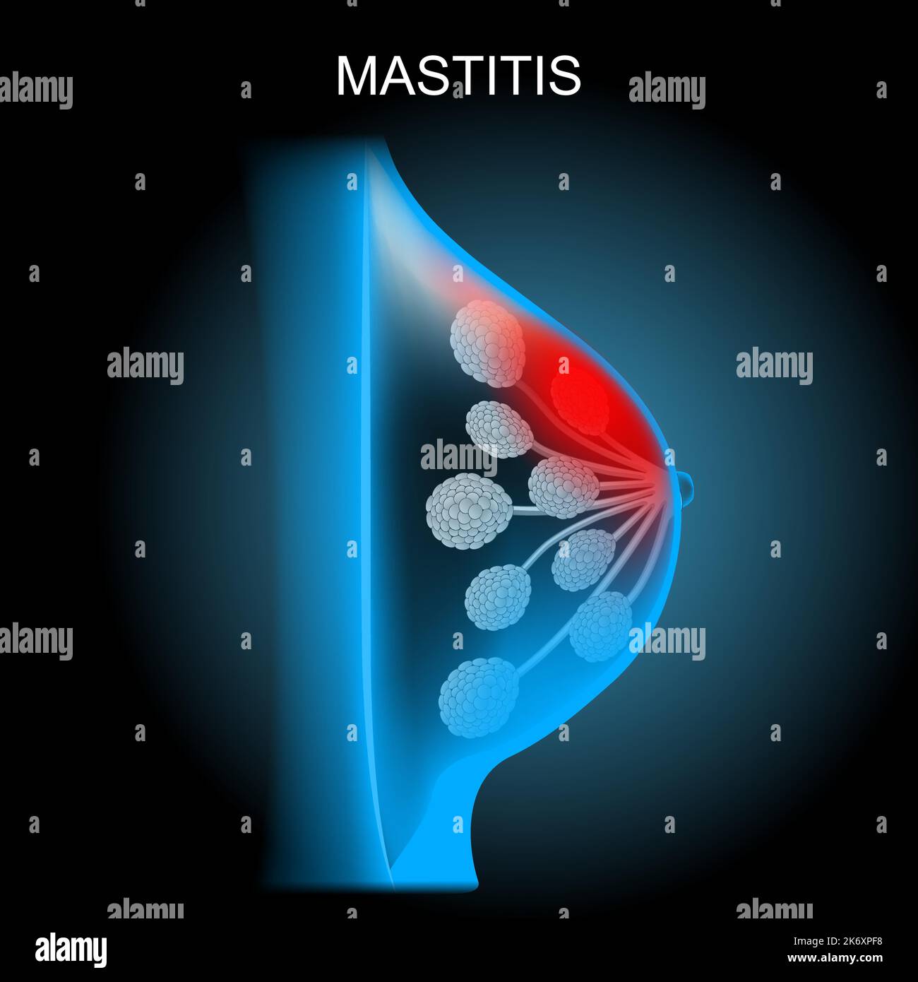 Mastitis. 3d realistic poster about inflammation of the breast. cross section of human mammary gland. x-ray blue scanning of a breast Stock Vector