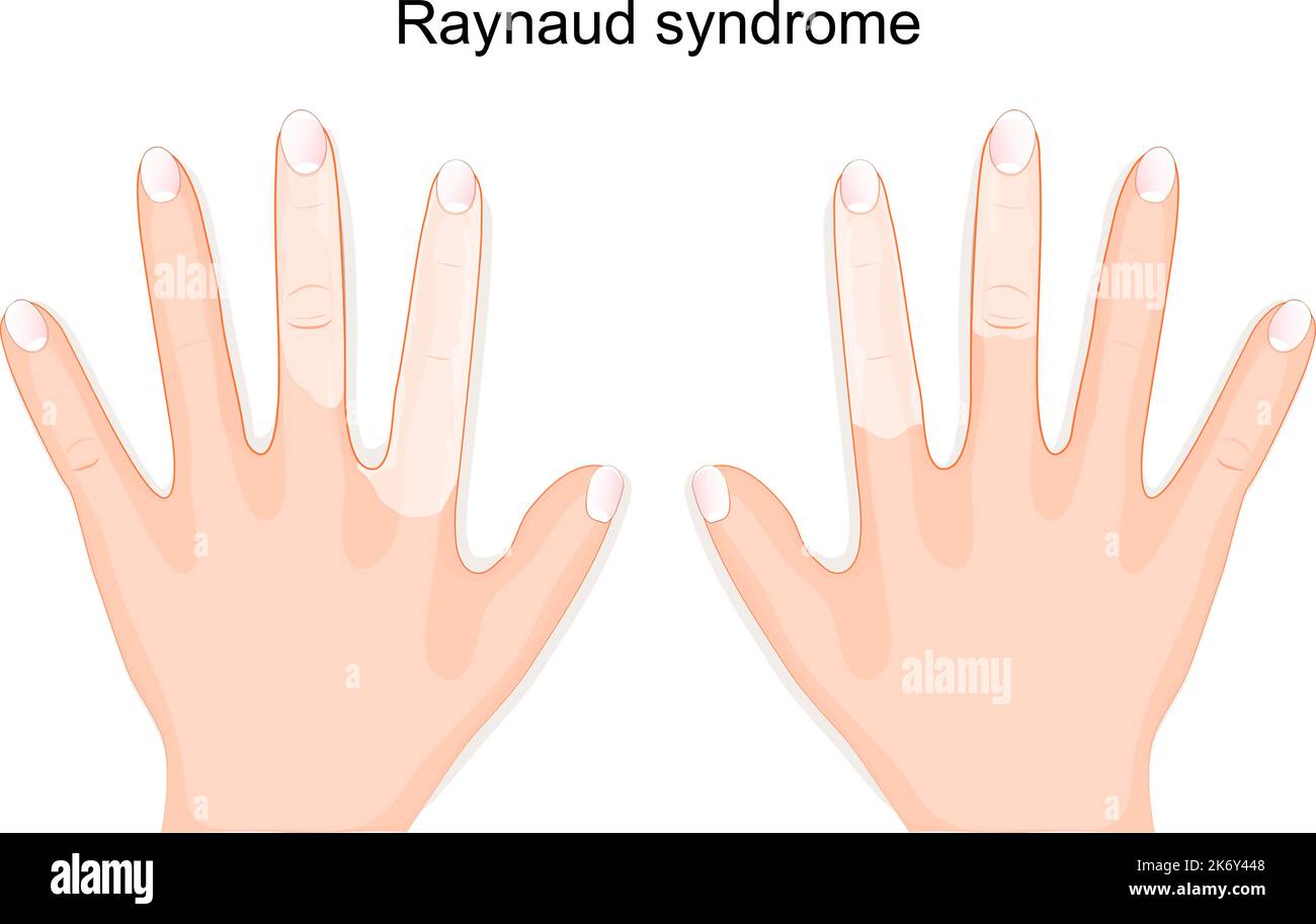 Raynaud syndrome. hands of a person with Raynaud's phenomenon during an attack. Vector illustration Stock Vector