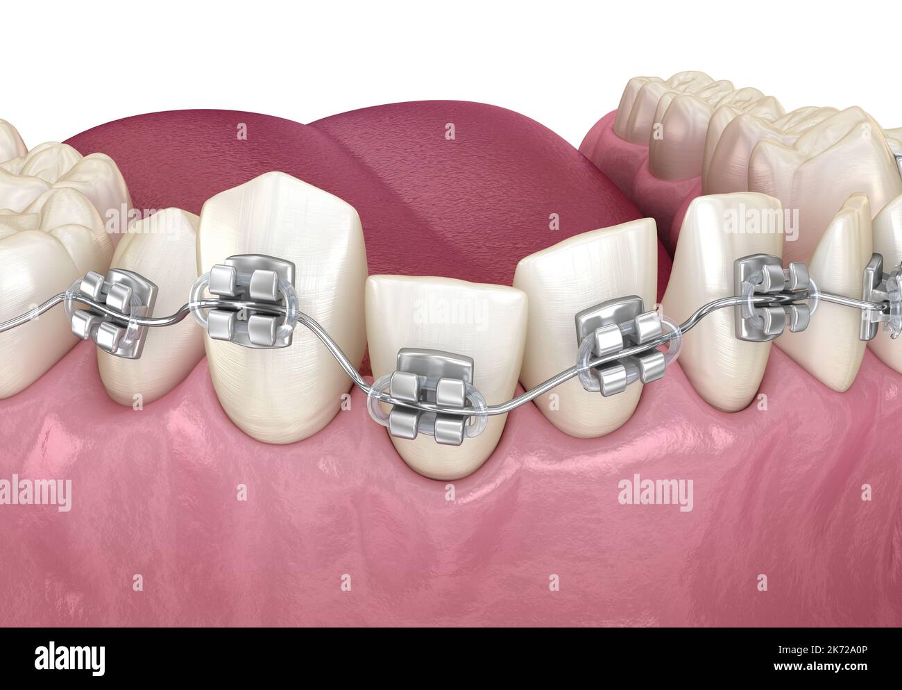 Abnormal teeth position and Clear braces tretament. Medically accurate dental 3D illustration Stock Photo