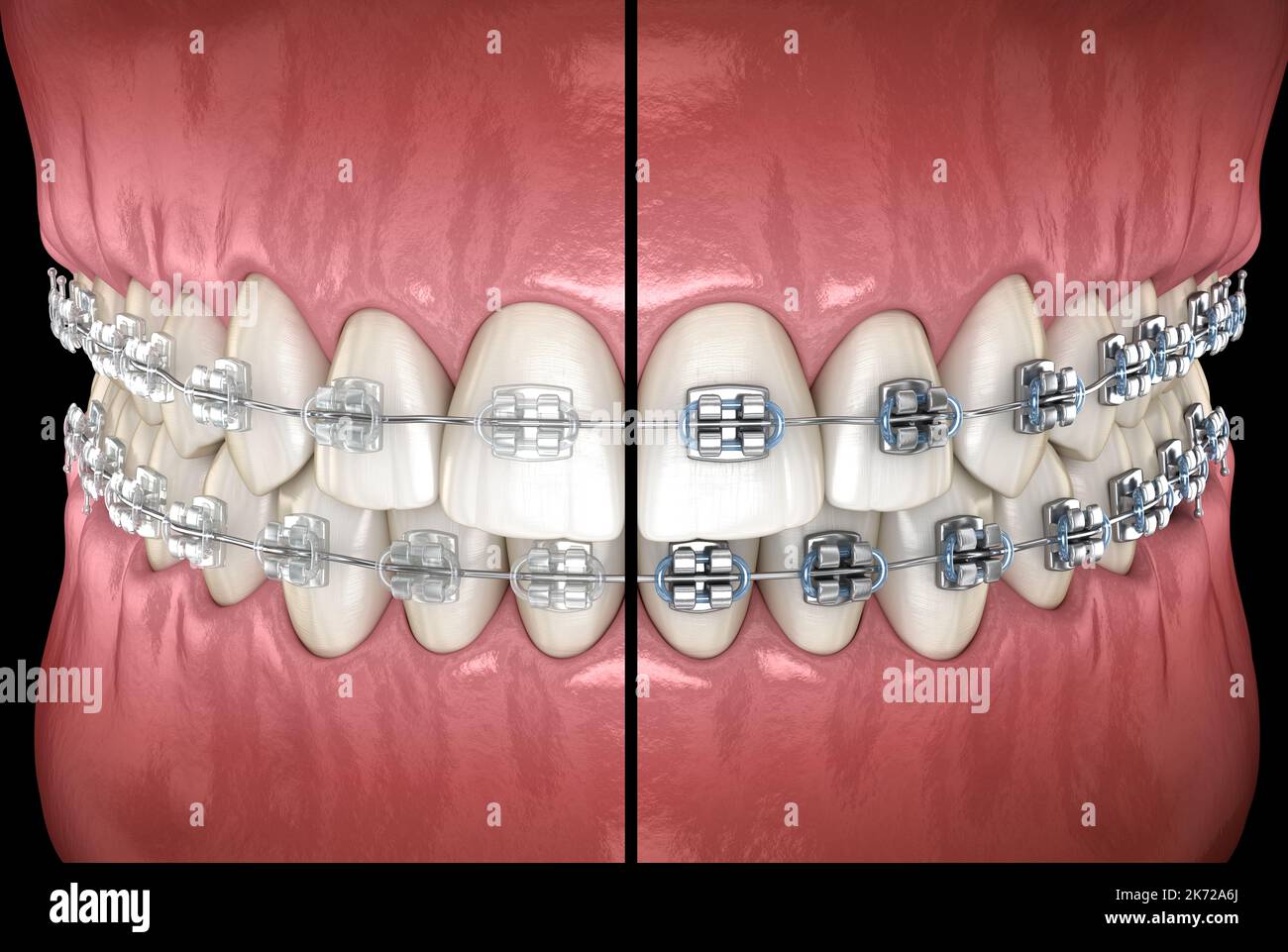 Clear braces versus Metal braces. Medically accurate dental 3D