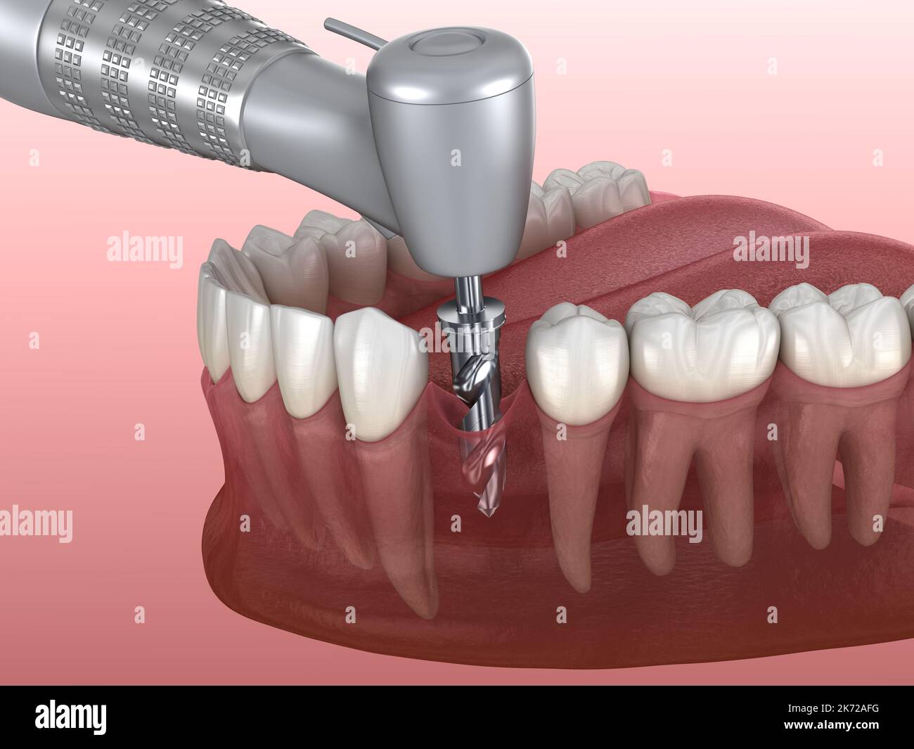 Drilling of bone while dental implant placement. Medically accurate 3D