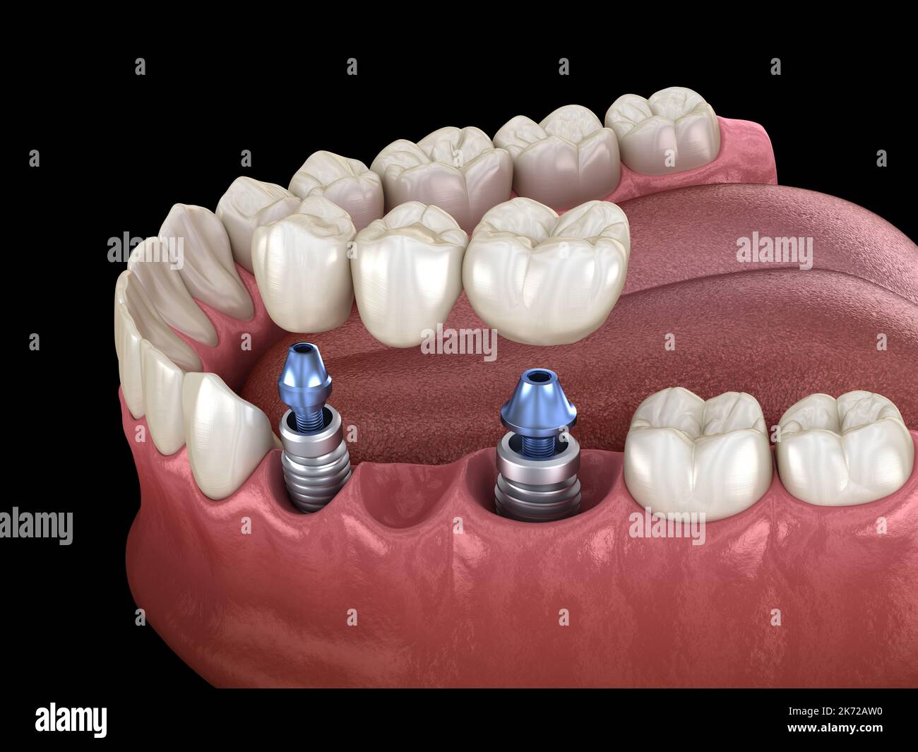 Dental bridge supported by implants. Medically accurate 3D illustration