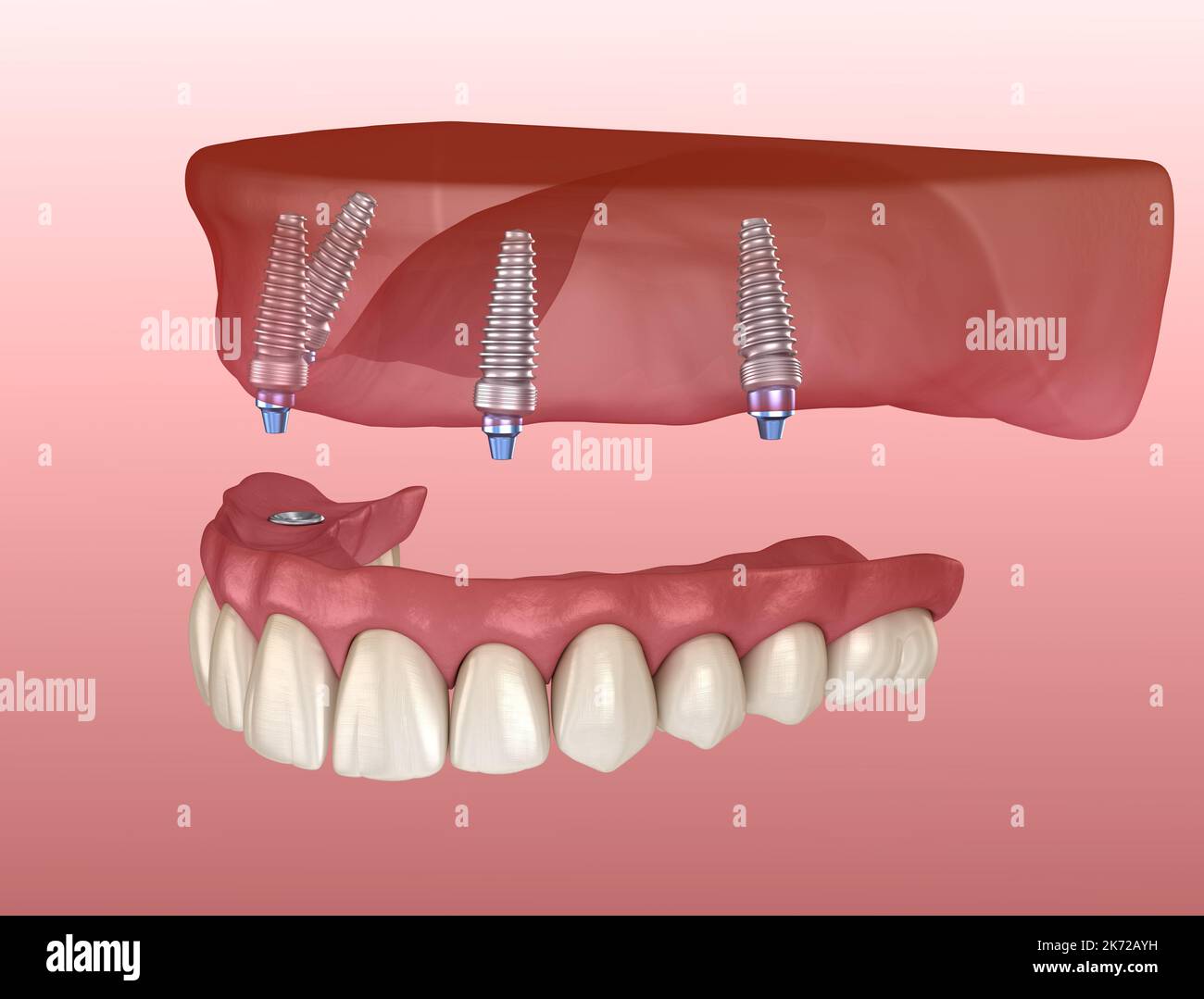 Maxillary Prosthesis Maxillary prosthesis with gum All on 4 system supported by implants ...