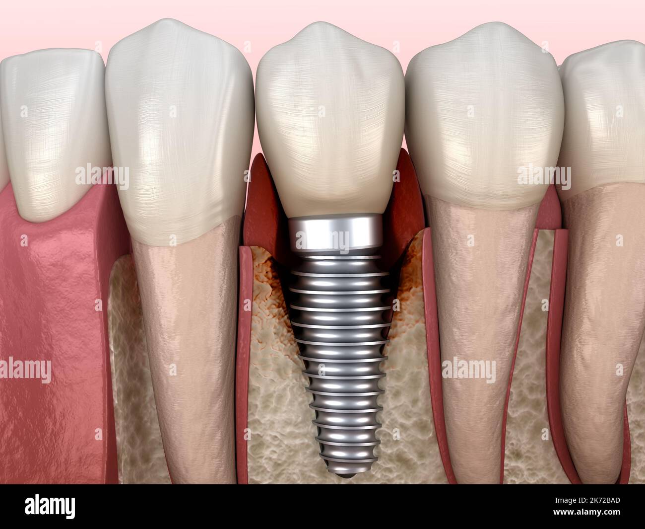 Periimplantitis with visible bone damage. Medically accurate 3D