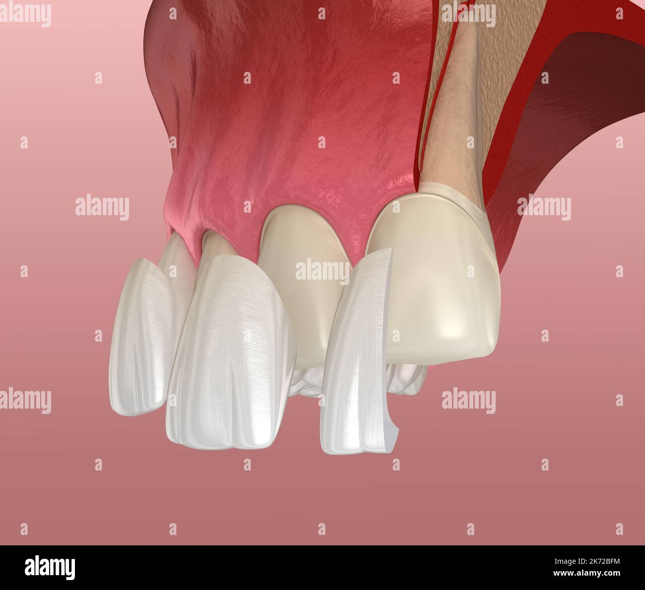 Veneer installation procedure over central incisor and lateral incisor
