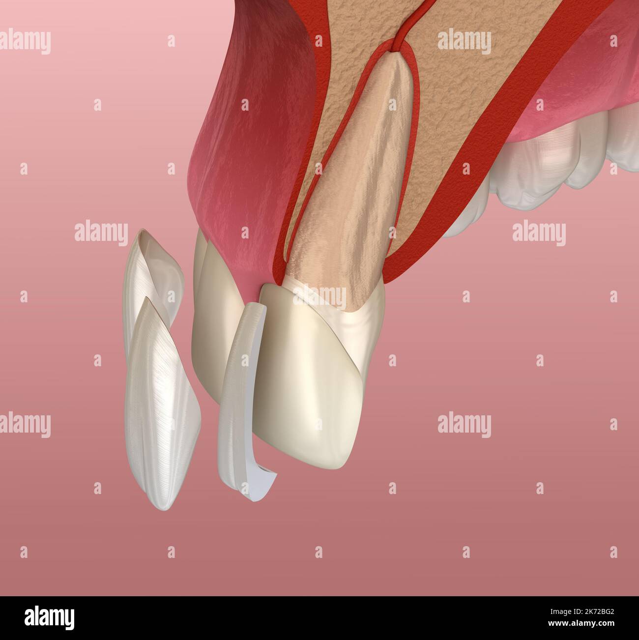 Veneer installation procedure over central incisor and lateral incisor