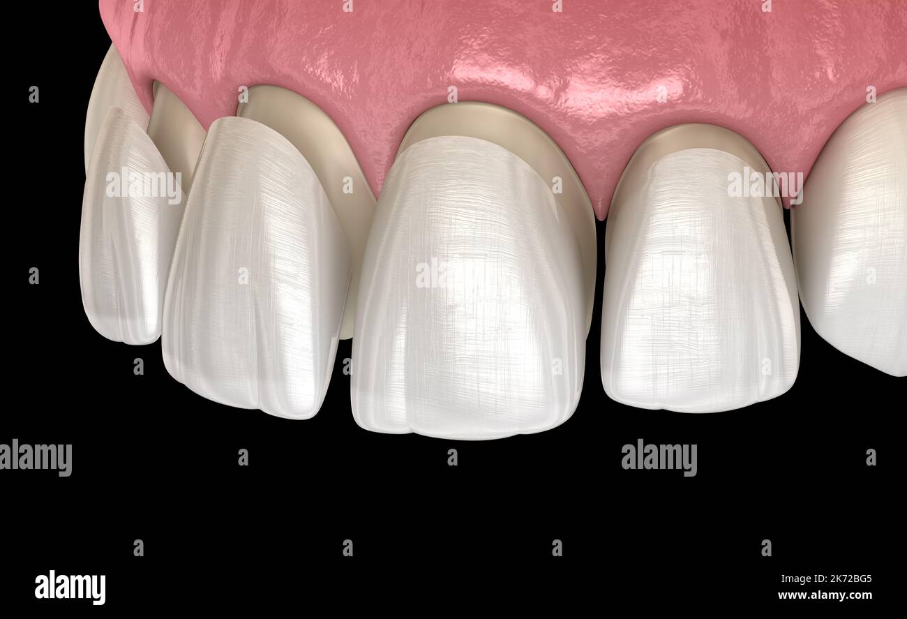 Veneer installation procedure over central incisor and lateral incisor