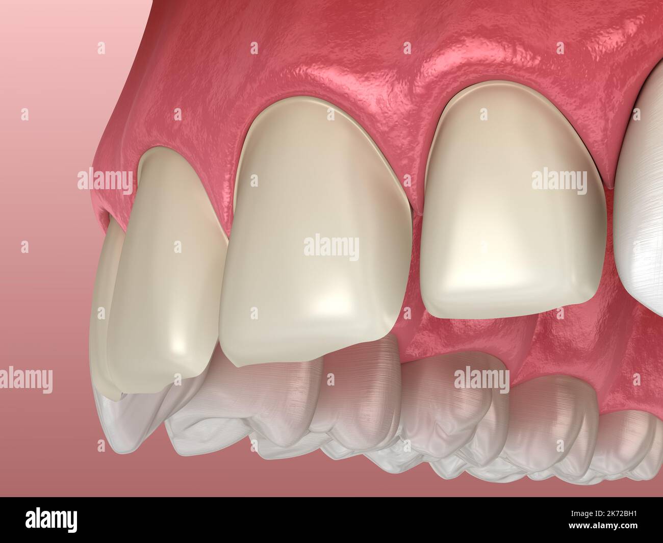 Teeth preparation for Veneer installation procedure over central