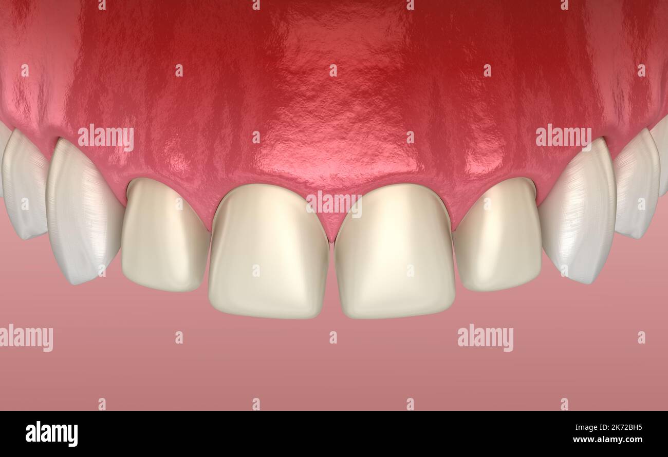 Teeth preparation for Veneer installation procedure over central