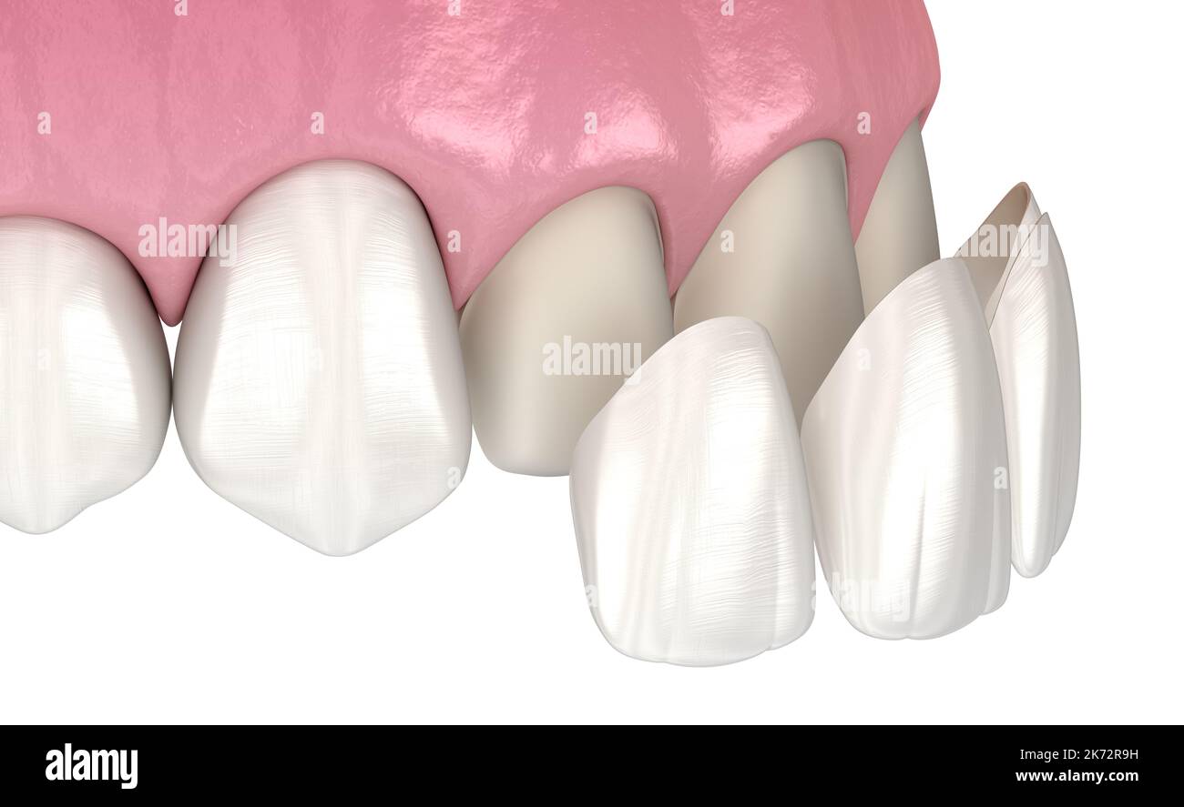 Veneer installation procedure over central incisor and lateral incisor