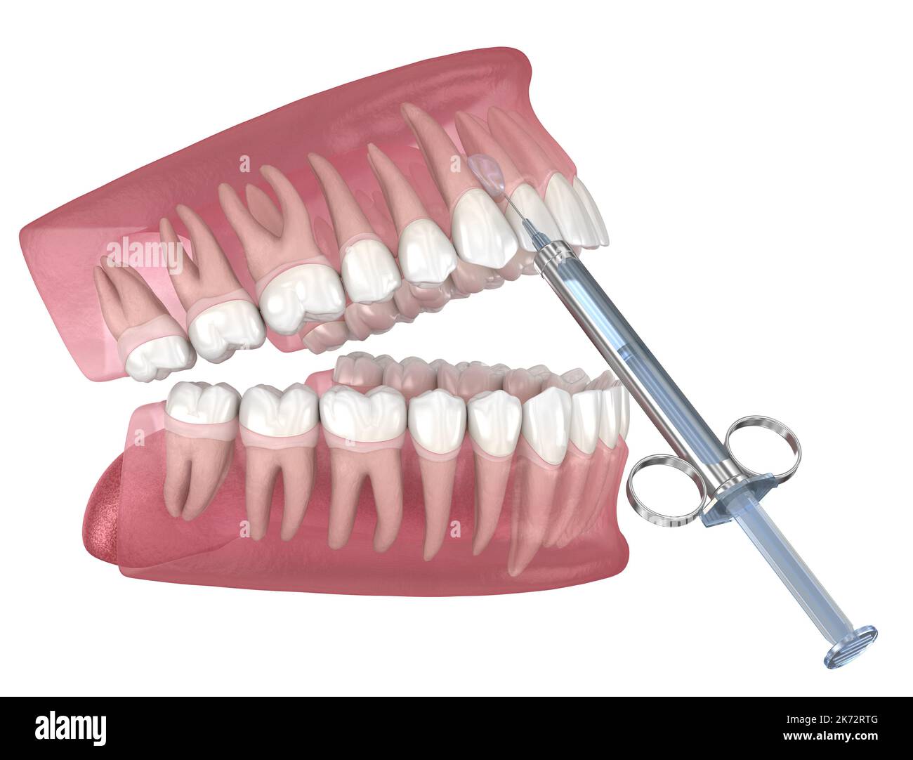 Local Dental anesthesia. 3D illustration of dental treatment Stock