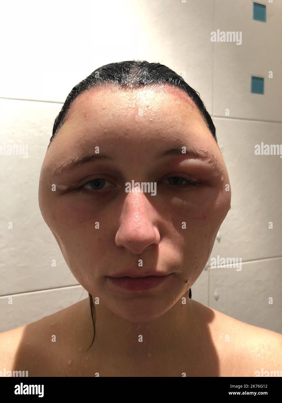 Allergic reaction hair dye hires stock photography and images Alamy