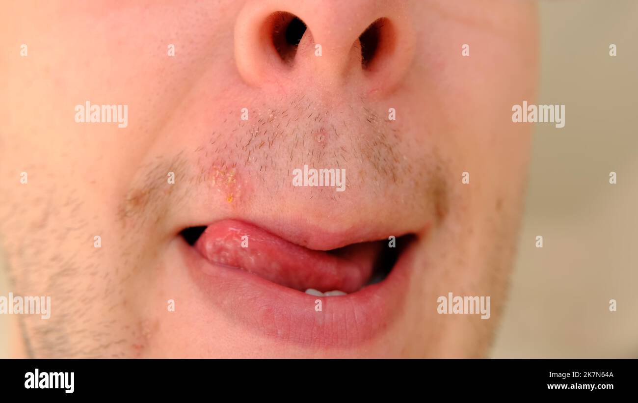 lie-bumps-herpes-virus