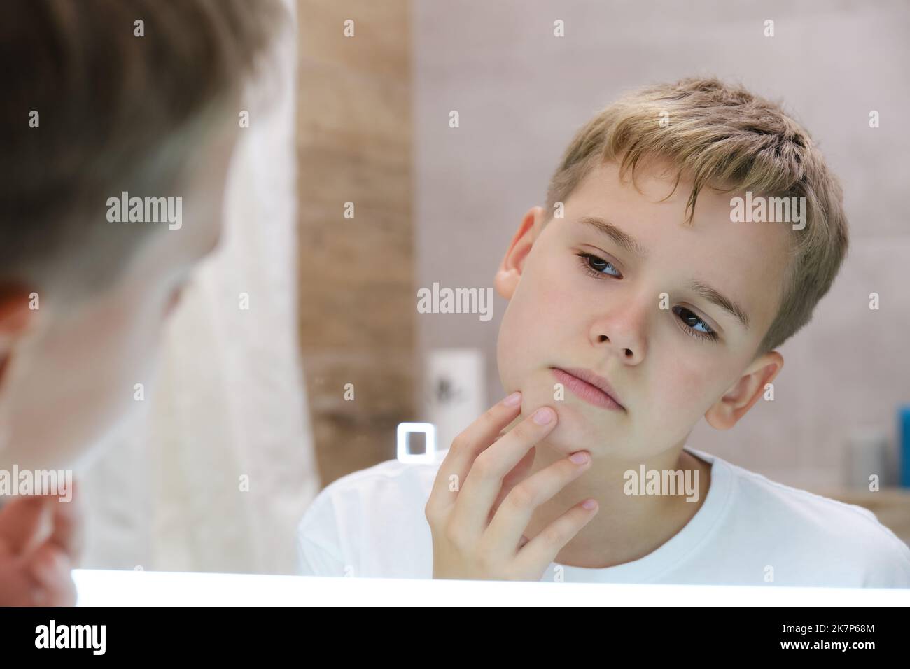 Teenager irritated by dry unhealthy skin, worried about problems with his face. Stock Photo