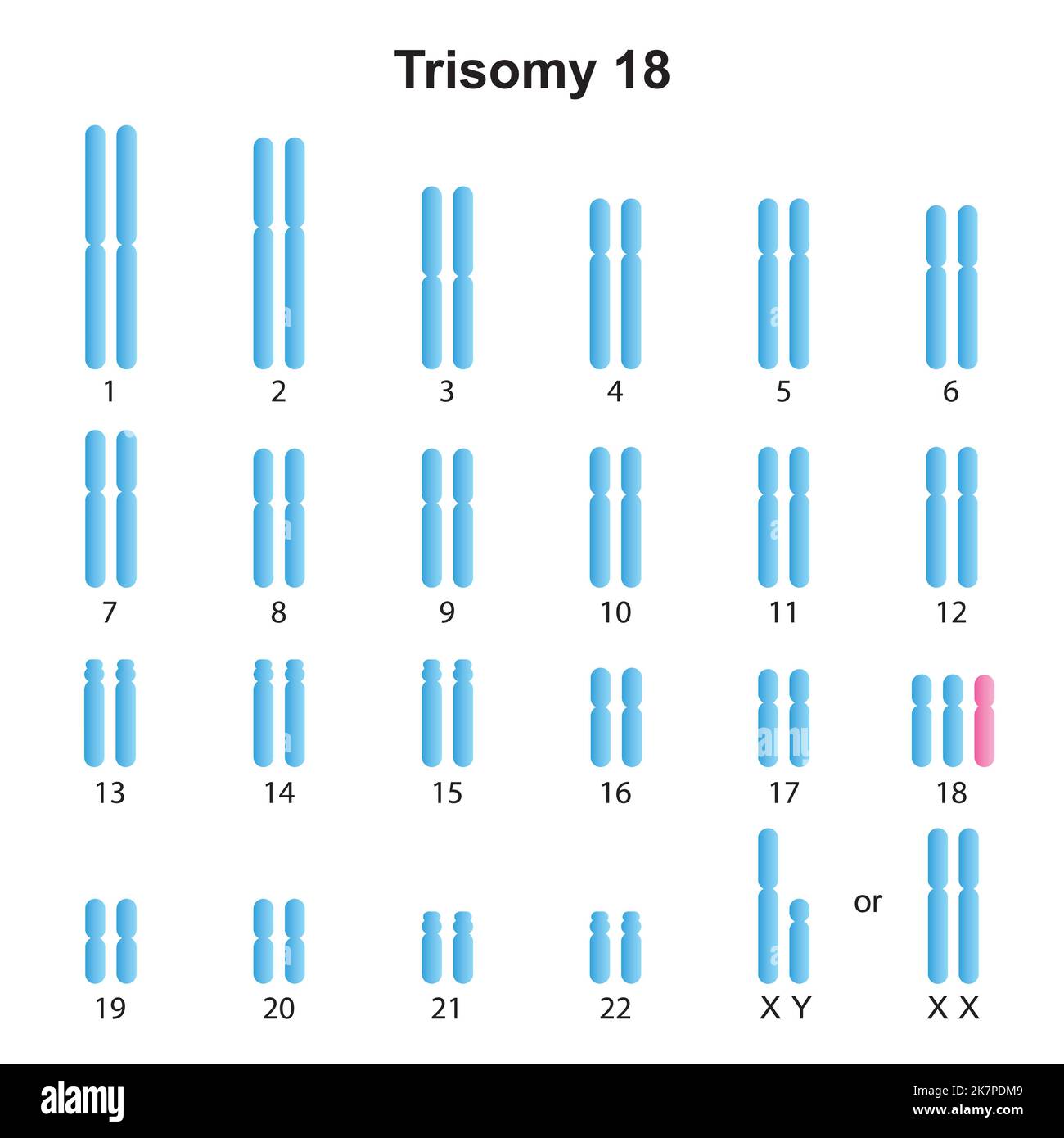 Edward Syndrome Chromosomes edward-syndrome-chromosomes