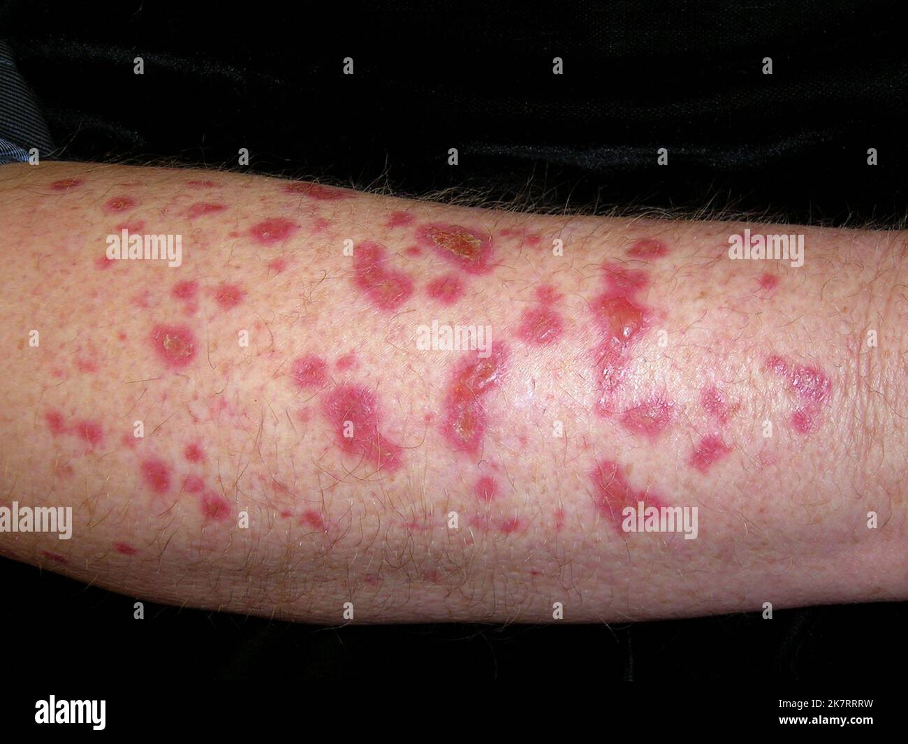 Actinic keratoses on the arm of a 61 year old white male patient ...