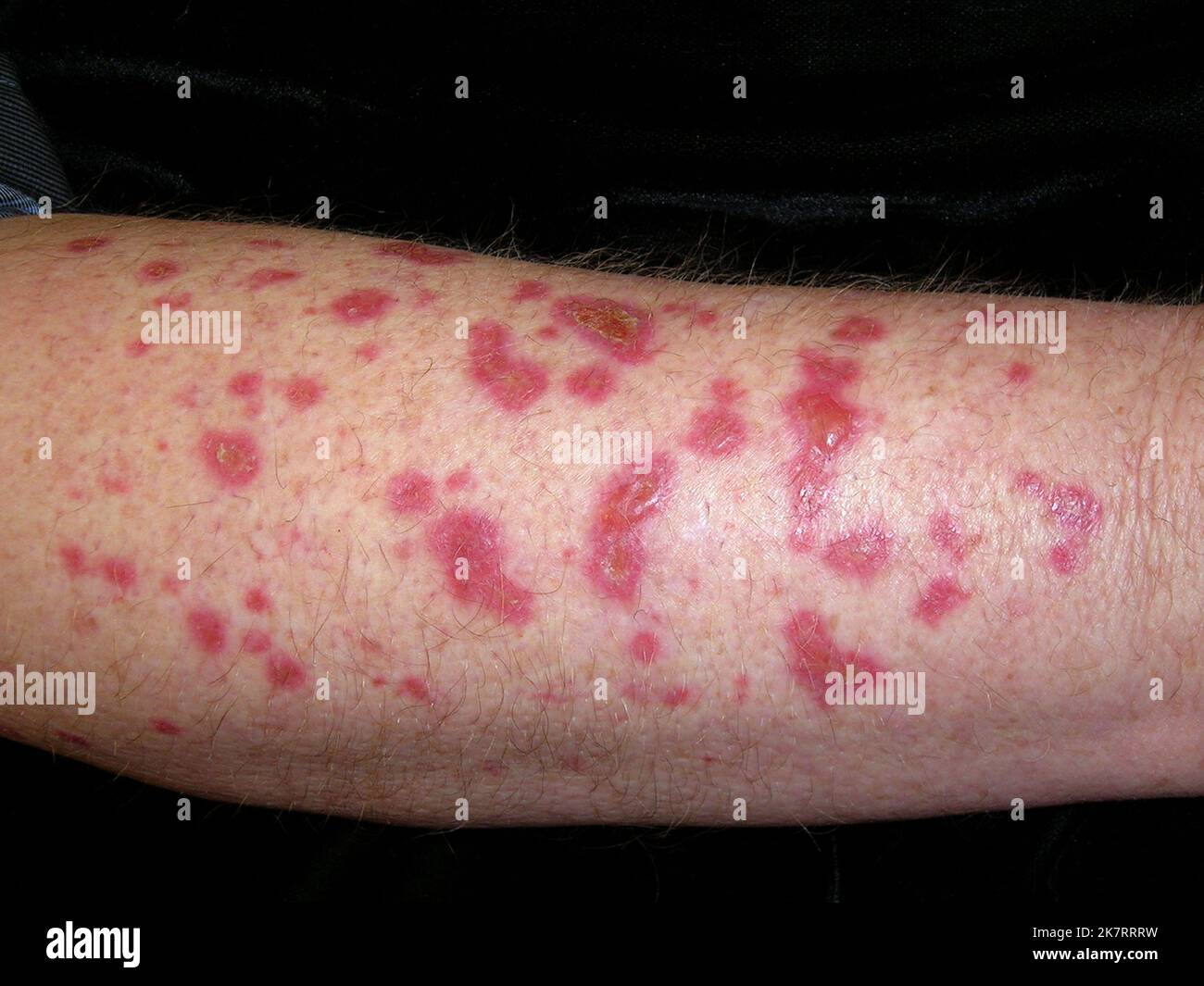 Actinic keratoses on the arm of a 61 year old white male patient
